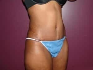 After Image: Tummy Tuck - front