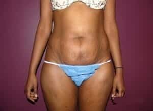 Before Image: Tummy Tuck - front