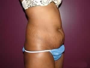Before Image: Tummy Tuck - front