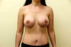 After Image: Tummy Tuck - front