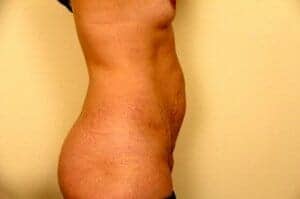 Before Image: Tummy Tuck - right-side