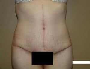 After Image: Tummy Tuck - front