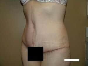 After Image: Tummy Tuck - left-front-oblique