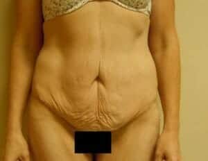 Before Image: Tummy Tuck - front