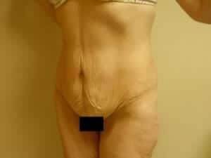 Before Image: Tummy Tuck - left-front-oblique
