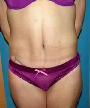 After Image: Tummy Tuck - front
