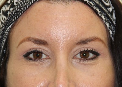 After Image: Brow Lift - front