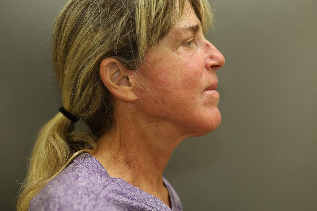 After Image: Facelift - front