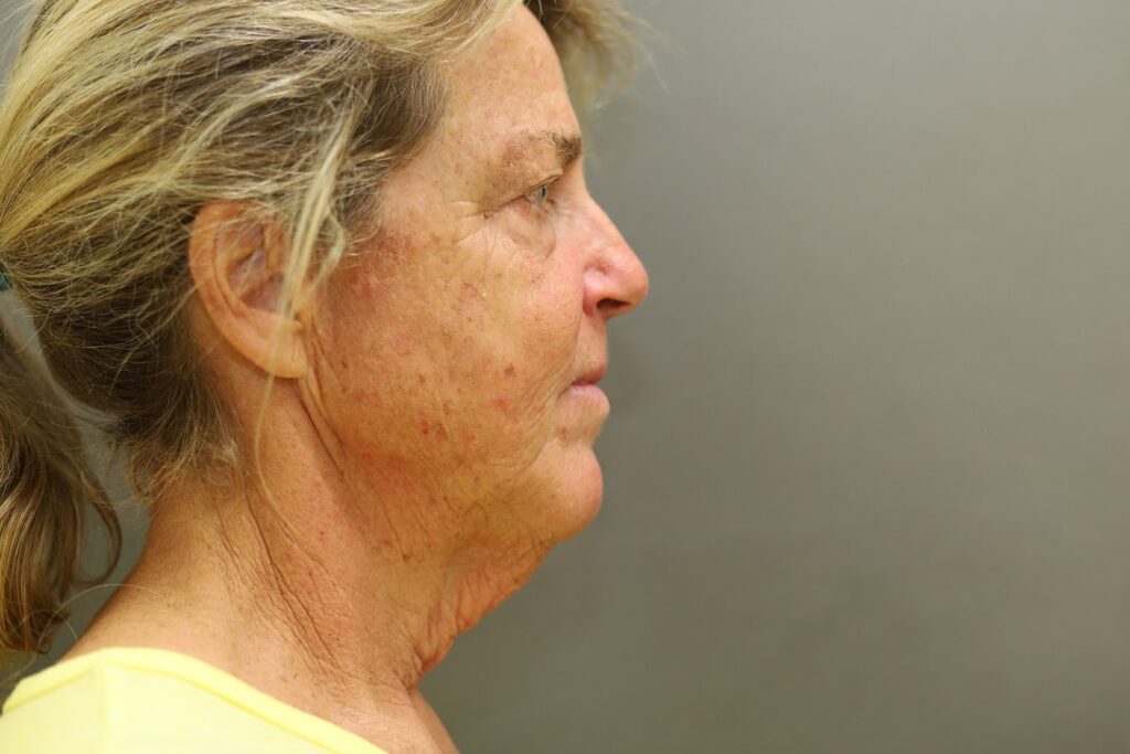 Before Image: Facelift - front