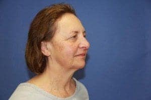 Before Image: Facelift - right-front-oblique