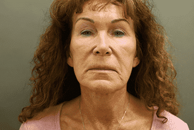Before Image: Facelift - front