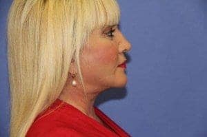 After Image: Facelift - right-side