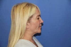 Before Image: Facelift - right-side