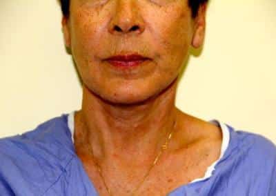 After Image: Facelift - front