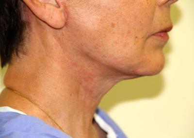 After Image: Facelift - right-side