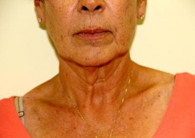 Before Image: Facelift - front