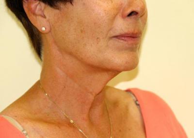 Before Image: Facelift - right-front-oblique