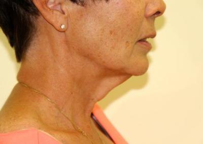 Before Image: Facelift - right-side