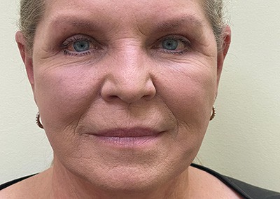 After Image: Facelift - front