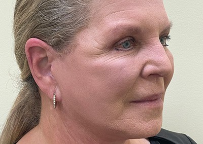 After Image: Facelift - front