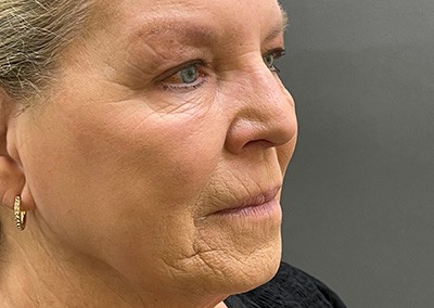 Before Image: Facelift - front