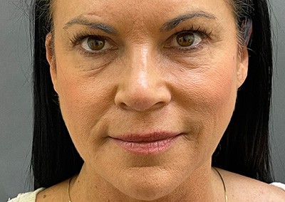 Before Image: Facelift - front