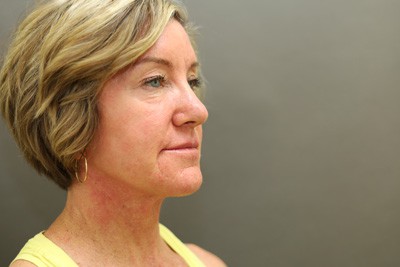 Before Image: Facelift - front