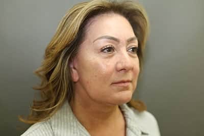 After Image: Facelift - front