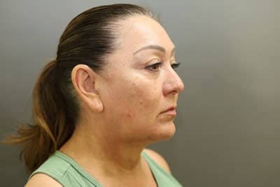 Before Image: Facelift - front