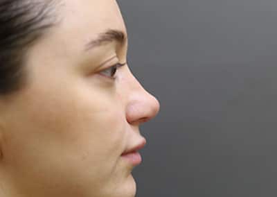 After Image: Facelift - right-side