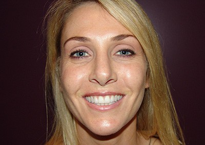 After Image: Revision Rhinoplasty - front