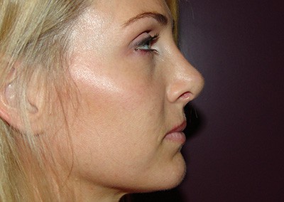 After Image: Revision Rhinoplasty - right-side