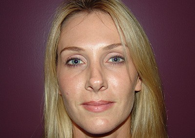 Before Image: Revision Rhinoplasty - front