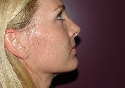Before Image: Revision Rhinoplasty - right-side