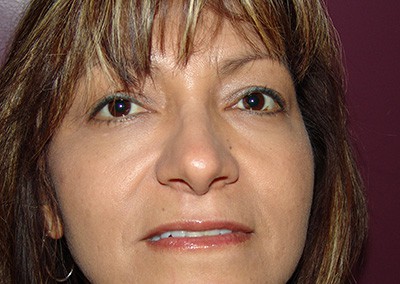 After Image: Revision Rhinoplasty - front