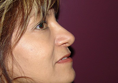 After Image: Revision Rhinoplasty - right-side