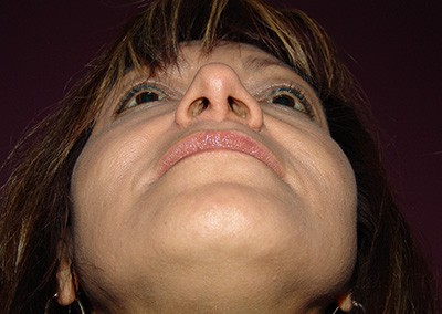 After Image: Revision Rhinoplasty - front