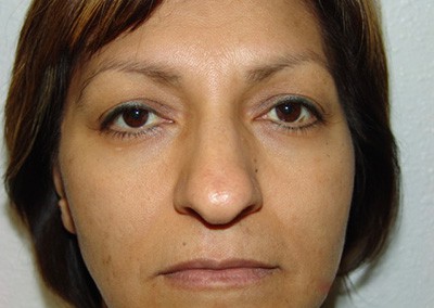 Before Image: Revision Rhinoplasty - front