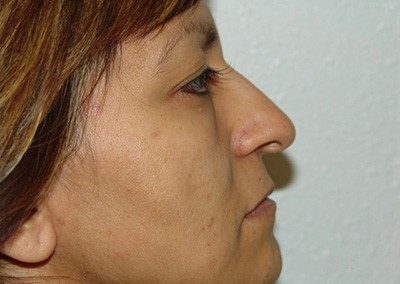 Before Image: Revision Rhinoplasty - right-side