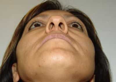 Before Image: Revision Rhinoplasty - front
