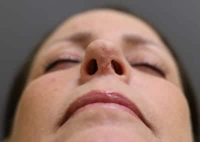 After Image: Revision Rhinoplasty - front