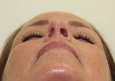 Before Image: Revision Rhinoplasty - front
