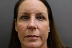 After Image: Revision Rhinoplasty - front