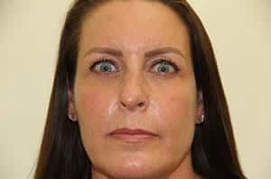 Before Image: Revision Rhinoplasty - front