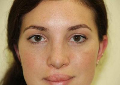 After Image: Rhinoplasty - front