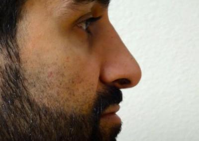After Image: Rhinoplasty - right-side