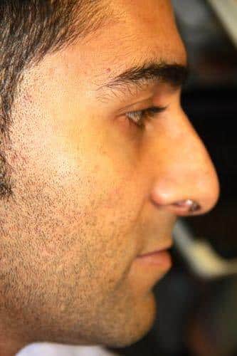 Before Image: Rhinoplasty - right-side