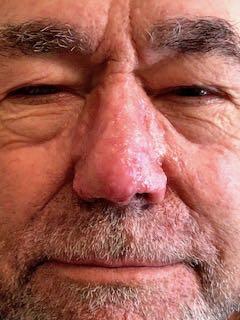 After Image: Rhinoplasty - front