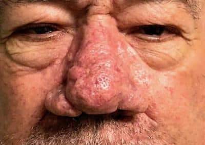 Before Image: Rhinoplasty - front