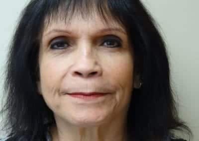 Before Image: Rhinoplasty - front